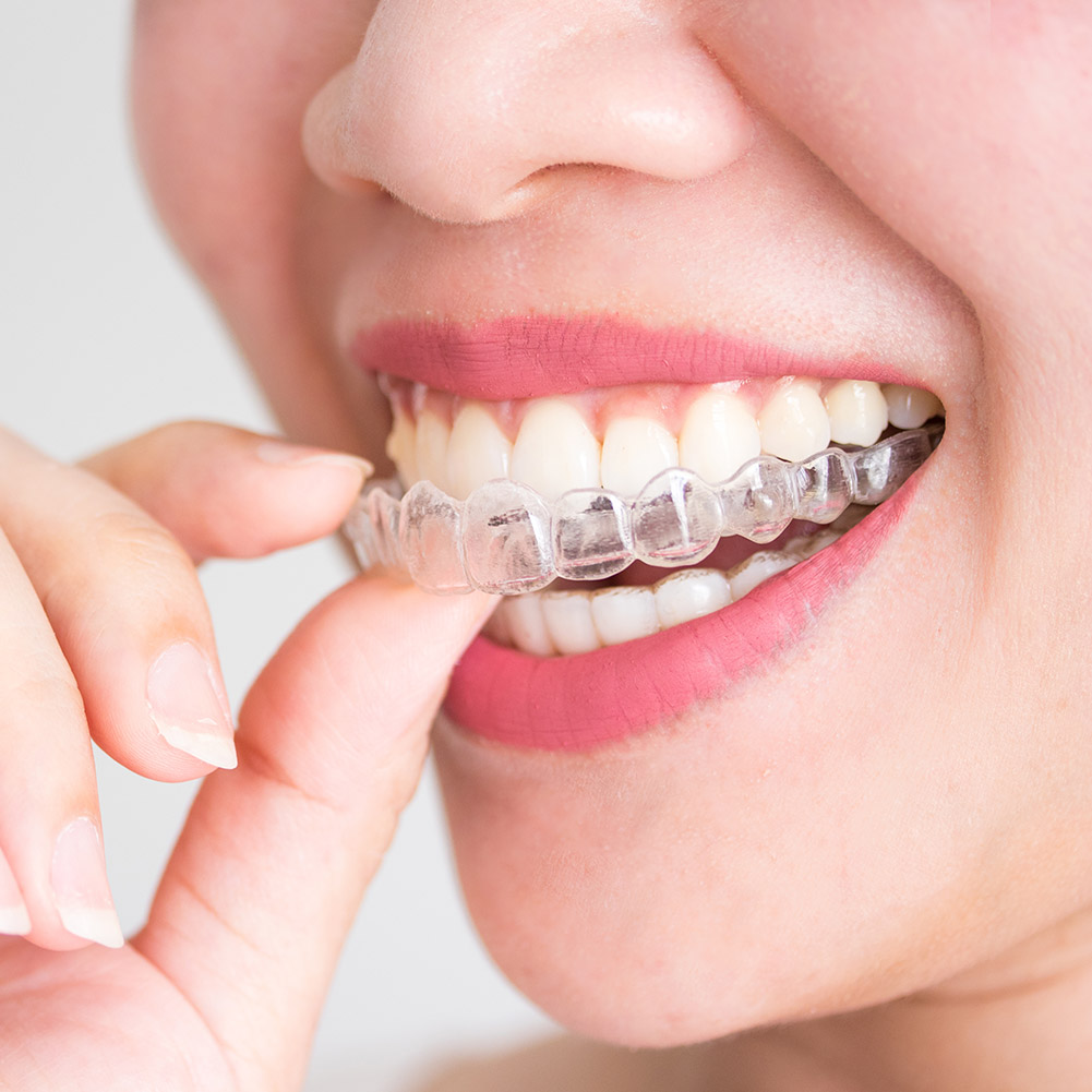 2/4pcs Professional Tooth Orth – Teeth Whitening With Trays recenzja i cena