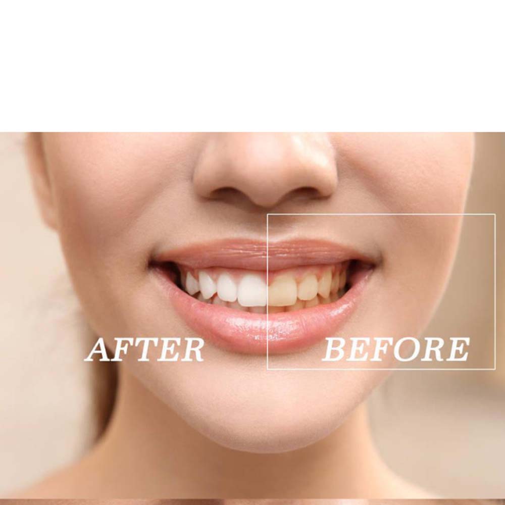 Top Quality Peroxide Teeth Whi – Teeth Whitening Led Kit recenzja i cena