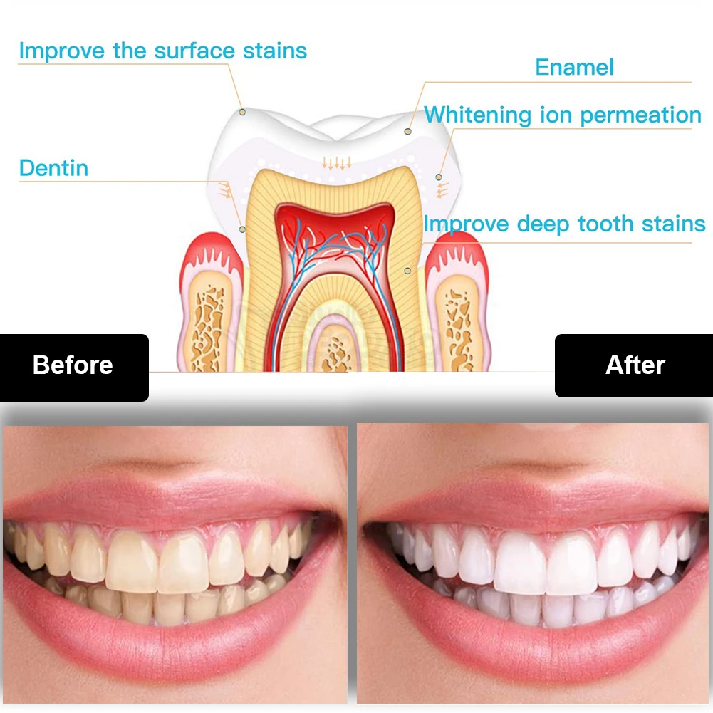 Dental Teeth Whitening Kit Min – Teeth Whitening With Hydrogen Peroxide recenzja i cena
