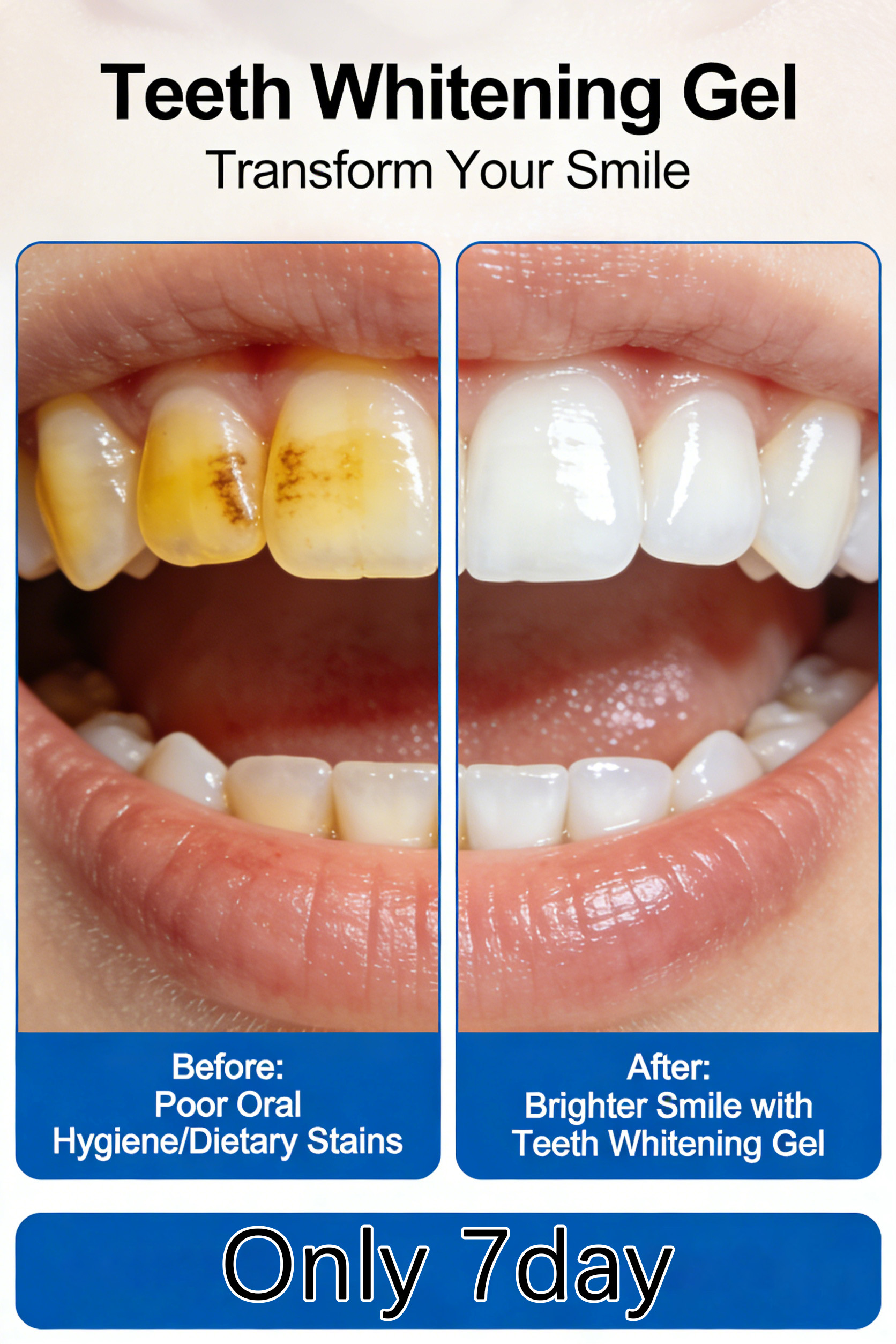 LED Teeth Whitening Gel Kit –  – Teeth Whitening Led Kit recenzja i cena